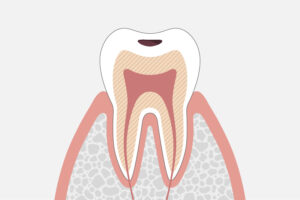 象牙質に達した虫歯