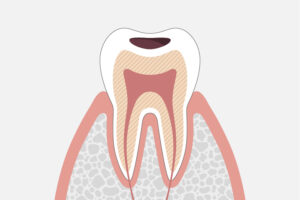 象牙質に達した虫歯