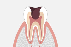 歯髄(神経)に達した虫歯